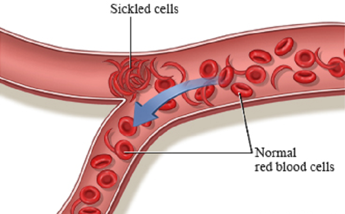 World  marks Sickle Cell Day